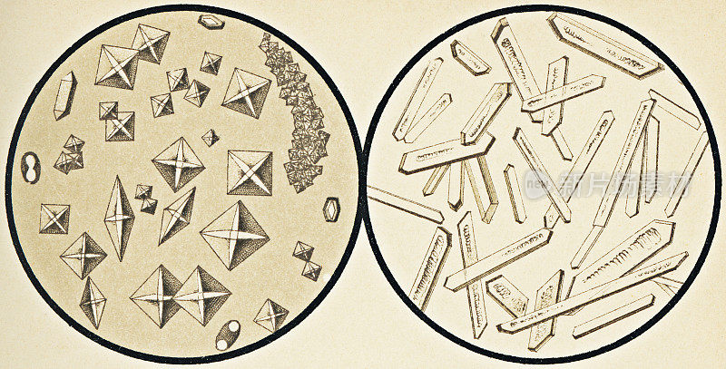从尿液沉积物中提取的草酸钙和马尿酸晶体的显微镜观察- 19世纪